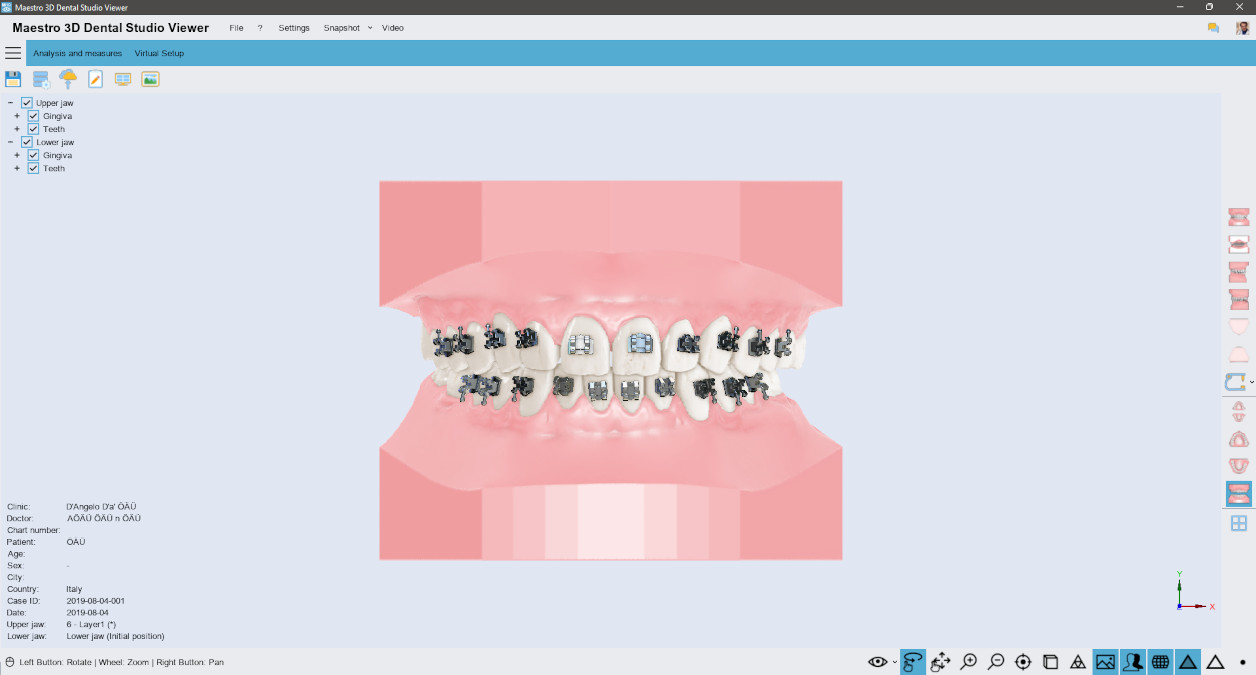 Deltaface, ArchForm, ONYXCEPH, 3Shape Ortho System, 3Shape Clear Aligner Studio, NemoCast, Nemotec, Ortho X Aligner, diorco, dentOne, 3dLeone, 3D Leone Designer, SureSmile Aligner, ulab, ulabsystems, blue sky bio, Maestro 3D, M3D, AGE Solutions, MDS500, Best orthodontic software, Bracket placement software, Digital study models, Rapid prototyping for dentistry, 3D scanner for jewelry, Dental scanner, Best dental scanner, Orthodontic software for clear aligners, Digital design of clear aligners, Orthodontic CAD/CAM software, Rapid prototyping for orthodontics, Guide for aligner production, Dental aligner software solutions, Digital creation of orthodontic appliances, 3D modeling for dental aligners, Direct 3D printing of clear aligners, Orthodontic correction software, Advanced technology for aligners, Software for expander design, Automatic aligner cutting, Ortho Studio Software, Dental Studio Software, Digital bands and expanders, Digital bite splint, Digital mouthguard, AI-based automatic tooth segmentation, AI-based digital orthodontics, Orthodontic treatment software, AI-powered dental aligner software, AI-driven digital dental aligners, AI software solutions for dental aligners, AI technology for orthodontic correction, AI-based orthodontic planning, Cloud-based dental aligner software, Cloud solutions for orthodontics, Web viewer for orthodontic cases